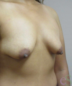 Breast Augmentation with Lift Patient 22 before photo. Individual results may vary.