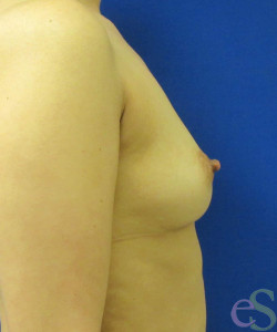 Breast Augmentation Patient 149 before photo. Individual results may vary.