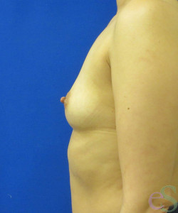 Breast Augmentation Patient 149 before photo. Individual results may vary.