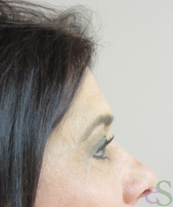 After Image: Blepharoplasty Patient 11 - left-side