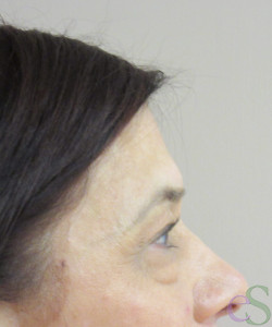 Before Image: Blepharoplasty Patient 11 - left-side