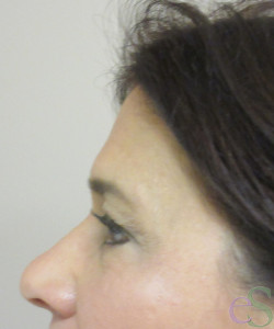 After Image: Blepharoplasty Patient 11 - right-side