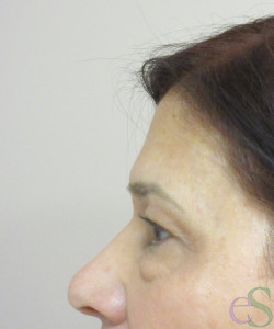 Before Image: Blepharoplasty Patient 11 - right-side
