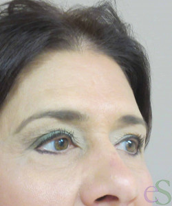After Image: Blepharoplasty Patient 11 - left-front-oblique
