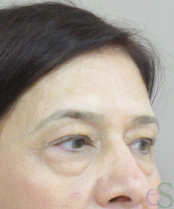 Before Image: Blepharoplasty Patient 11 - left-front-oblique