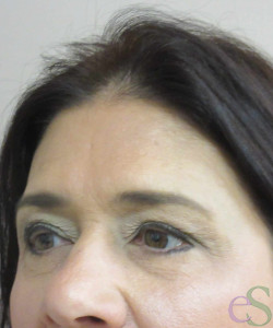 After Image: Blepharoplasty Patient 11 - right-front-oblique
