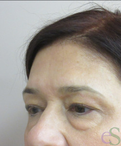 Before Image: Blepharoplasty Patient 11 - right-front-oblique