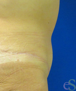 After Image: Tummy Tuck Patient 54 - left-side