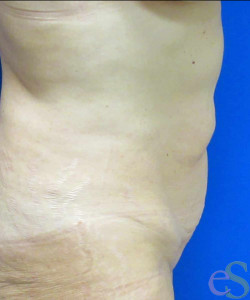 Before Image: Tummy Tuck Patient 54 - left-side