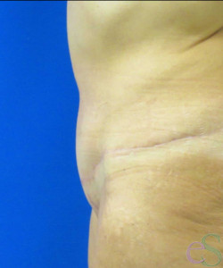 After Image: Tummy Tuck Patient 54 - right-side