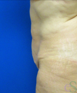 Before Image: Tummy Tuck Patient 54 - right-side