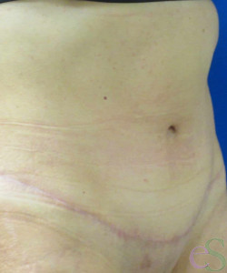 After Image: Tummy Tuck Patient 54 - left-front-oblique