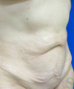 Before Image: Tummy Tuck Patient 54 - left-front-oblique