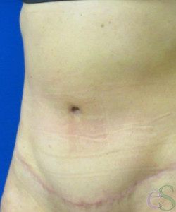 After Image: Tummy Tuck Patient 54 - right-front-oblique