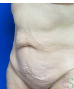 Before Image: Tummy Tuck Patient 54 - right-front-oblique