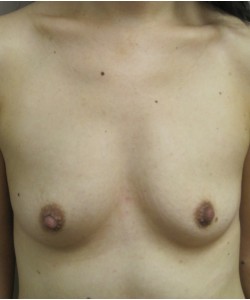 Breast Augmentation Patient 11 before photo. Individual results may vary.