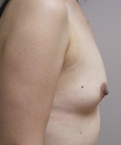 Breast Augmentation Patient 11 before photo. Individual results may vary.