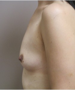 Breast Augmentation Patient 11 before photo. Individual results may vary.