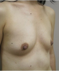 Breast Augmentation Patient 11 before photo. Individual results may vary.
