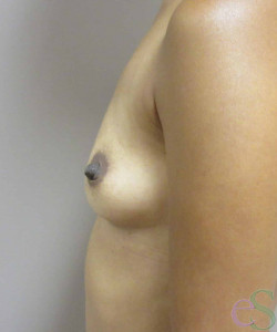 Breast Augmentation Patient 158 before photo. Individual results may vary.