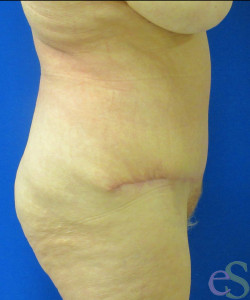 After Image: Tummy Tuck Patient 56 - left-side