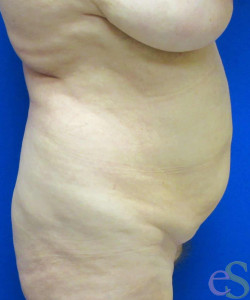 Before Image: Tummy Tuck Patient 56 - left-side