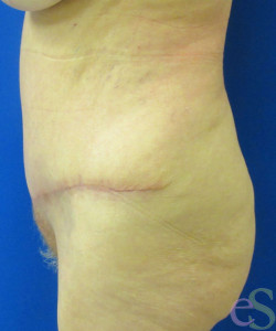After Image: Tummy Tuck Patient 56 - right-side