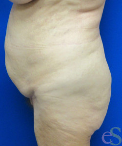 Before Image: Tummy Tuck Patient 56 - right-side