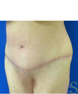 After Image: Tummy Tuck Patient 56 - left-front-oblique