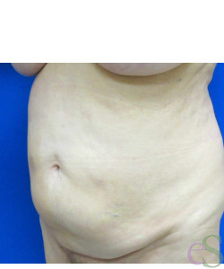 Before Image: Tummy Tuck Patient 56 - left-front-oblique