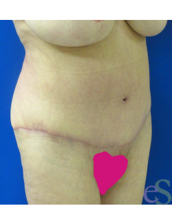 After Image: Tummy Tuck Patient 56 - right-front-oblique