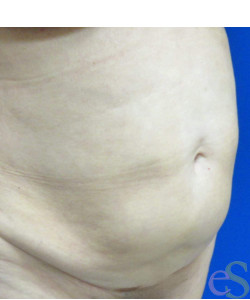 Before Image: Tummy Tuck Patient 56 - right-front-oblique