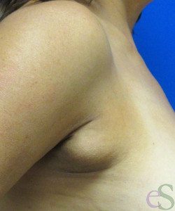 Axillary Breast Reduction Patient 1 before photo. Individual results may vary.