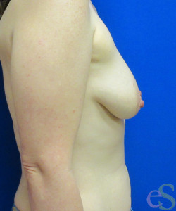 Breast Augmentation with Lift Patient 24 before photo. Individual results may vary.