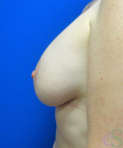Breast Augmentation with Lift Patient 24 after photo. Individual results may vary.