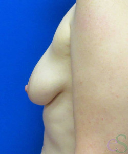 Breast Augmentation with Lift Patient 24 before photo. Individual results may vary.