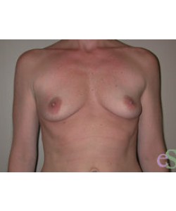 Breast Augmentation Patient 14 before photo. Individual results may vary.