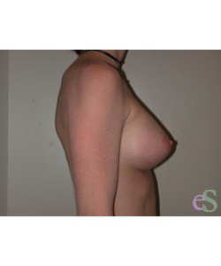Breast Augmentation Patient 14 after photo. Individual results may vary.