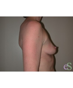 Breast Augmentation Patient 14 before photo. Individual results may vary.