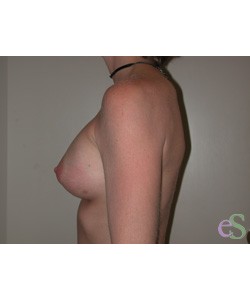 Breast Augmentation Patient 14 after photo. Individual results may vary.
