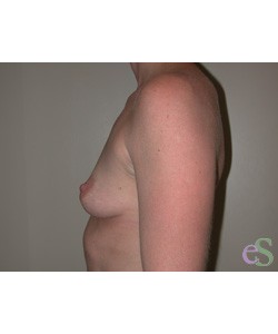 Breast Augmentation Patient 14 before photo. Individual results may vary.
