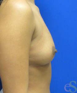 Breast Augmentation Patient 162 before photo. Individual results may vary.