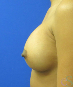 Breast Augmentation Patient 162 after photo. Individual results may vary.
