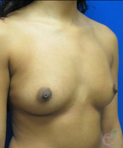 Breast Augmentation Patient 162 before photo. Individual results may vary.