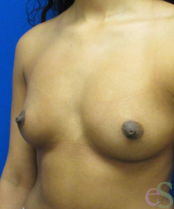 Breast Augmentation Patient 162 before photo. Individual results may vary.