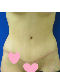 Tummy Tuck Patient 61 after photo. Individual results may vary.
