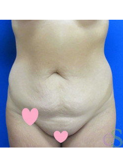 Tummy Tuck Patient 61 before photo. Individual results may vary.