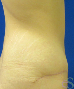 Tummy Tuck Patient 61 after photo. Individual results may vary.