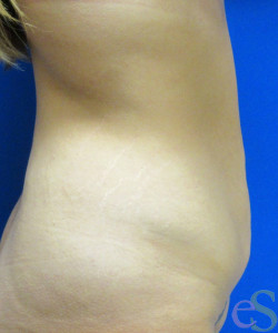 Tummy Tuck Patient 61 before photo. Individual results may vary.