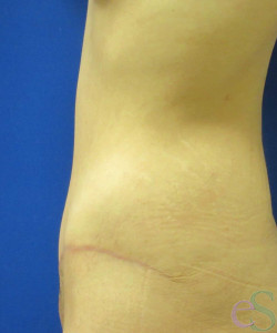 Tummy Tuck Patient 61 after photo. Individual results may vary.